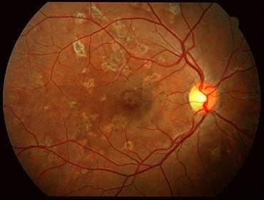 Uveitis