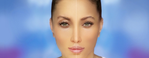 Example of upper eyelid blepharoplasty eyelid procedure