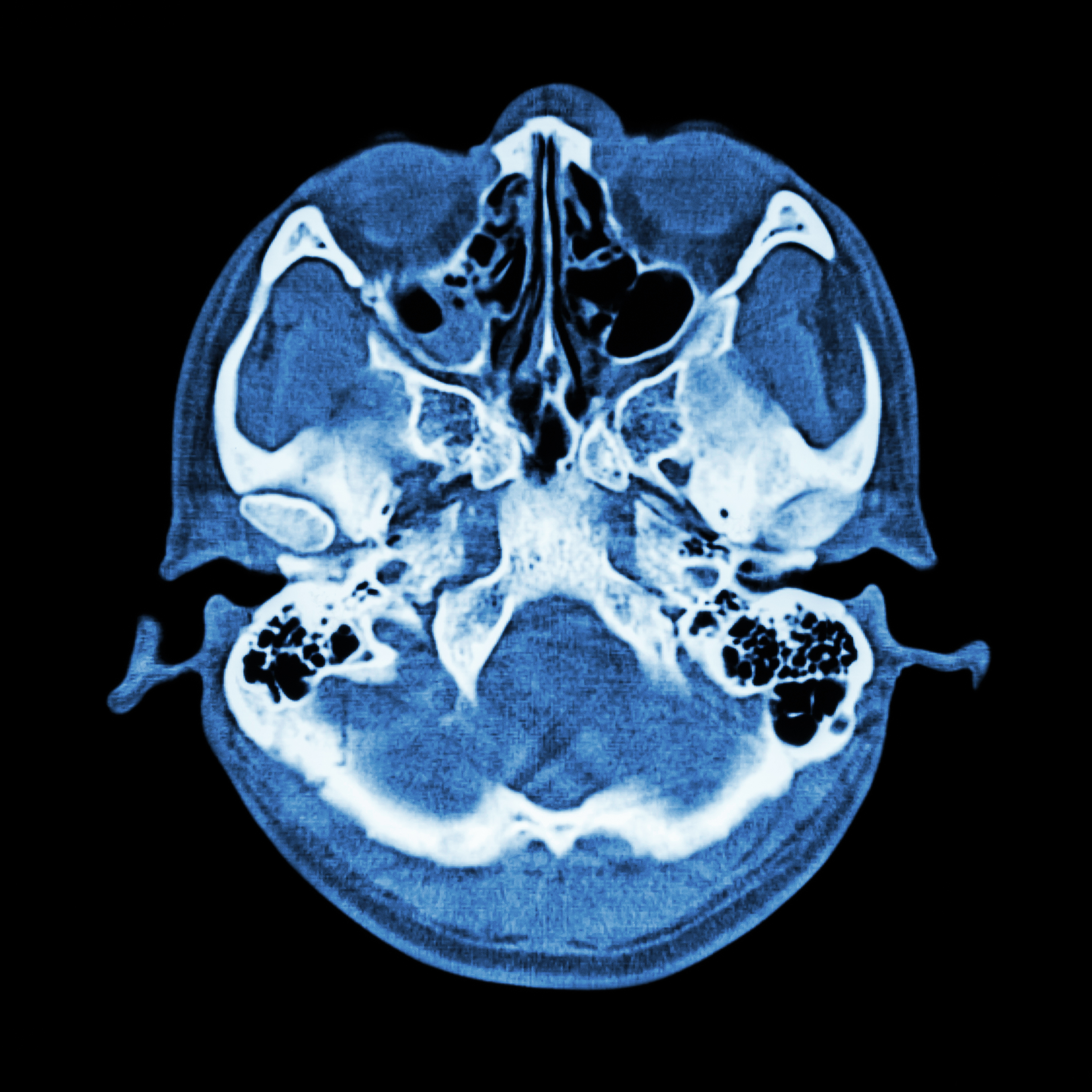 The skull, the main area for skull base surgery