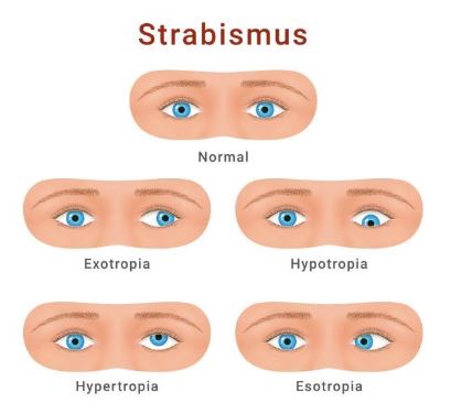 Different versions of strabismus, including exotropia, hypotropia, hyperopia, and esotropia