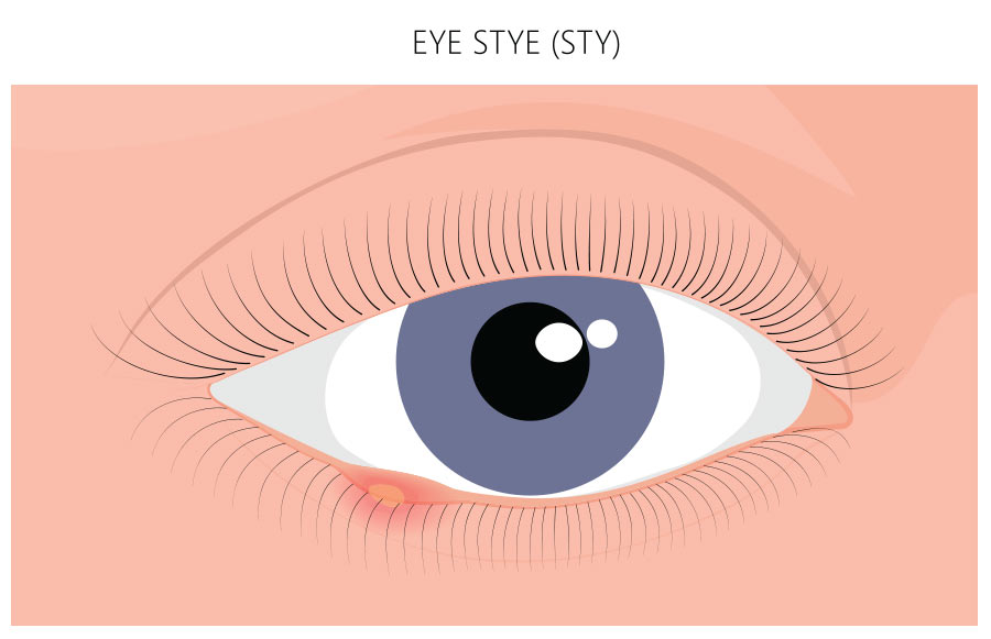Stye and Chalazion can be treated at home or by an eye care professional