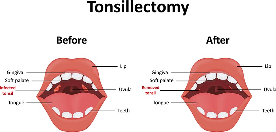 Tonsillitis