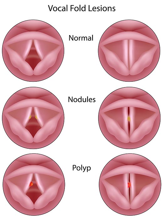 Vodal fold lesions